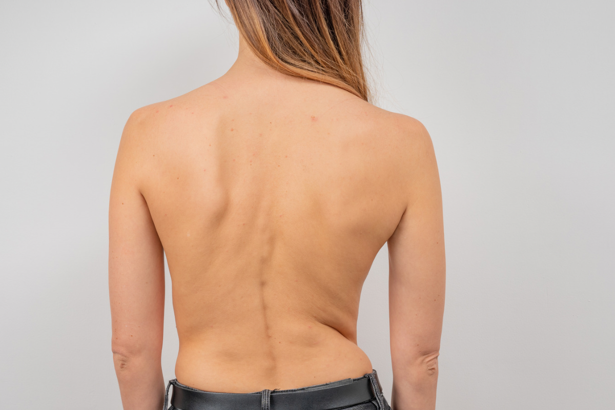 Scolioza: Mituri și realități despre această afecțiune&hellip;