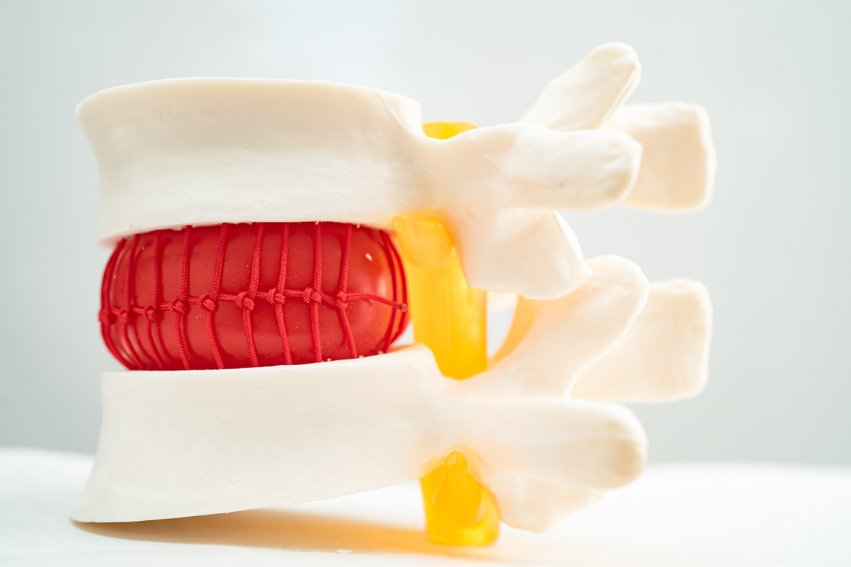 Cum ajută kinetoterapia să tratezi hernia de disc&hellip;